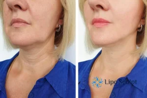Double chin before and after Hi-Fu treatment 4 Book your double chin treatment East Sussex today! We are here to help!