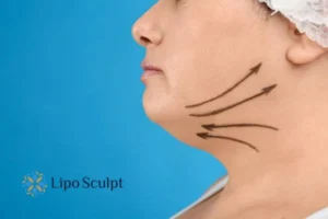 Double chin before and after Hi-Fu treatment 3 Boost your confidence with a Double chin treatment East Sussex