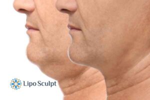 Double chin before and after Hi-Fu treatment 2 Double chin treatment East Sussex from Lipo Sculpt - feel more confident today!