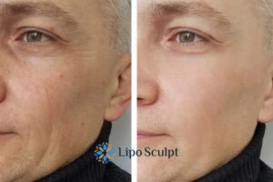 How to Fight Aging Symptoms 3 Fight Aging Symptoms East Sussex With HIFU and Morpheus8 Today!