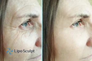 How to Fight Aging Symptoms 2 Do you want to Fight Aging Symptoms East Sussex? Contact Lipo Sculpt today!