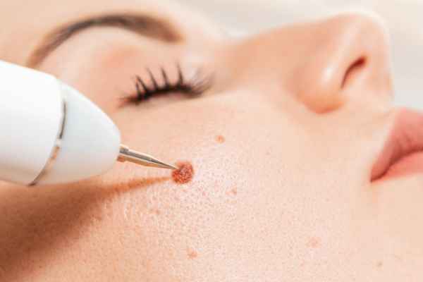 CryoPen: 5 Skin Concerns It May Be Used to Treat 3 What actually happens during a CryoPen treatment East Sussex?
