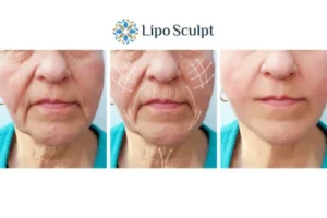Explaining Morpheus8 And What It Can Do For You 3 Boost your confidence with Morpheus8 East Sussex call our team today!