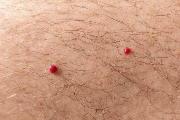 CryoPen: 5 Skin Concerns It May Be Used to Treat 2 cherry angioma removal East Sussex