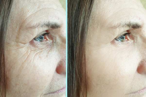 Why Do People Choose HIFU for a Non-Surgical Facelift? 4 How long can HIFU results last East Sussex?