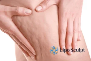 CoolSculpting for Legs: The Innovative Approach to Redefining Your Legs 5 Start your journey today book your coolsculpting treatment East Sussex online today!