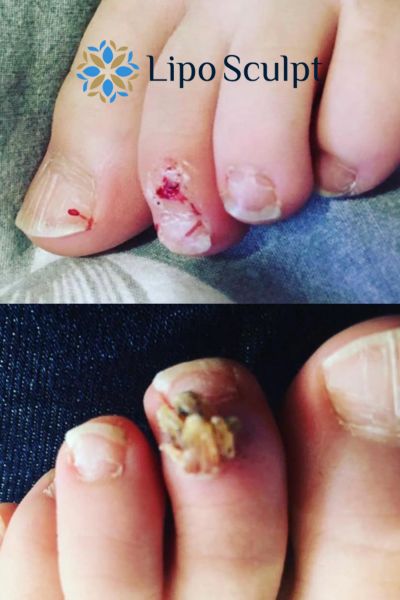 Wart removal customer results from Lipo Sculpt East Sussex