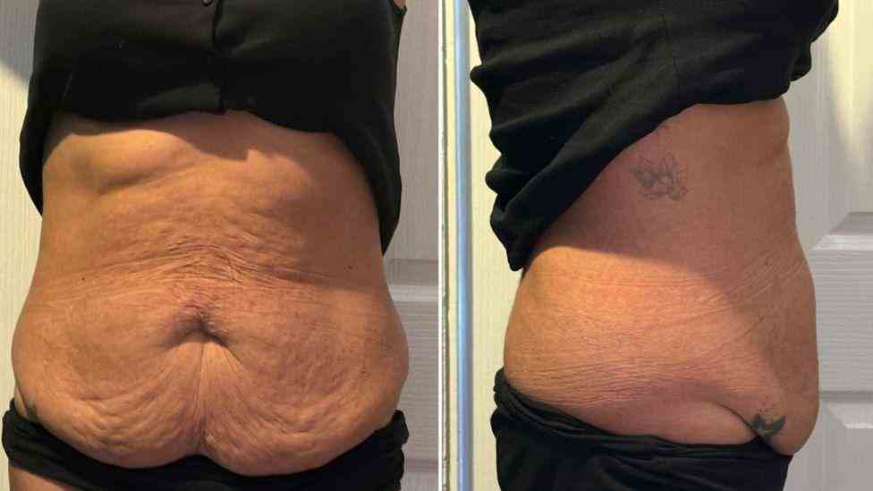 Lost the Weight but Not the Loose Skin? What You Should Know 1 Is It Definitely Loose Skin East Sussex?